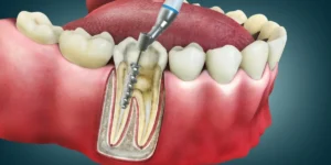 Root Canal