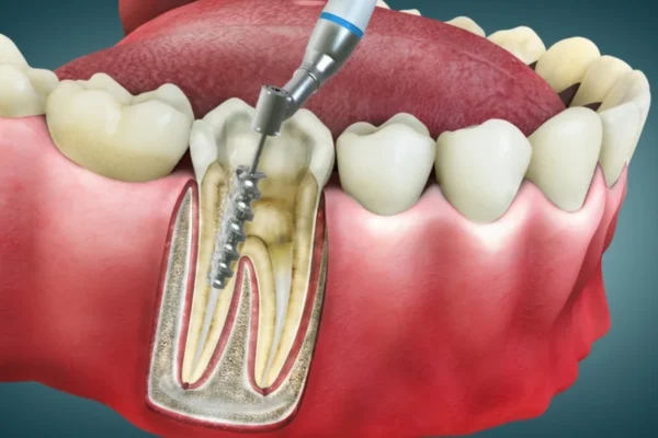 Root Canal